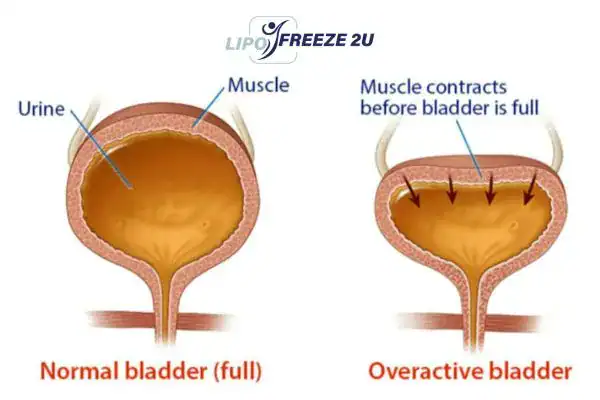 diagram of overactive bladder treatment Newbury