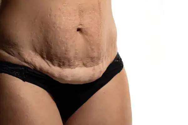loose skin after weight loss injections Newbury