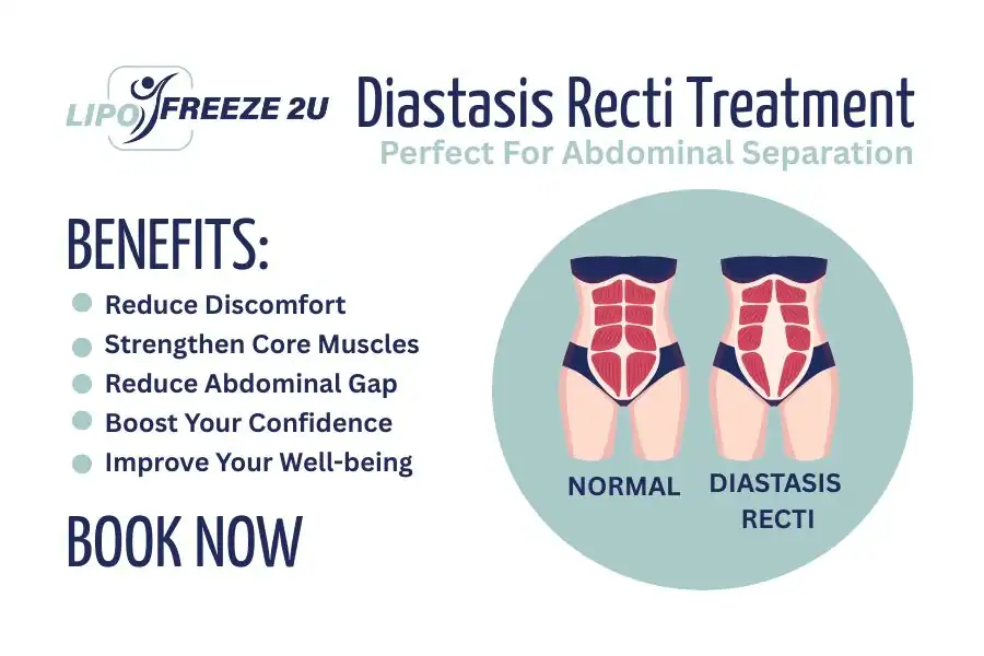 How Long Will It Take to See Improvements in Diastasis Recti Newbury