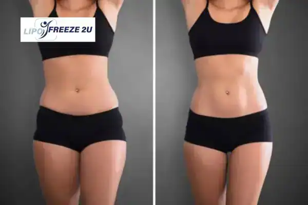 How Can LIPO FREEZE 2U Support Your Post-Pregnancy Body Recovery Newbury?