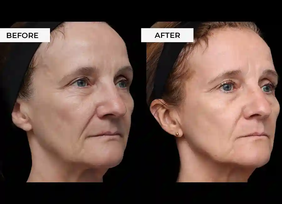 How Many RF Microneedling Sessions Will You Need to See a Difference Newbury?
