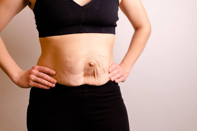 Is Surgery Really the Only Way to Repair Diastasis Recti Newbury?