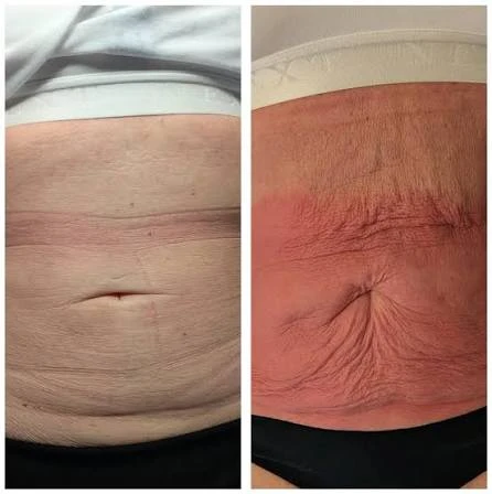 How Does RF Microneedling Improve Crepey, Thin and Uneven Skin Texture Newbury?
