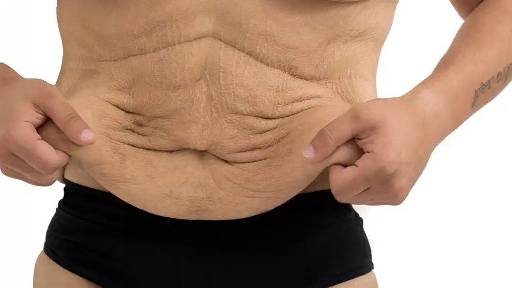 RF Microneedling for Loose Skin: How Can It Help Tighten and Reshape the Skin Newbury?